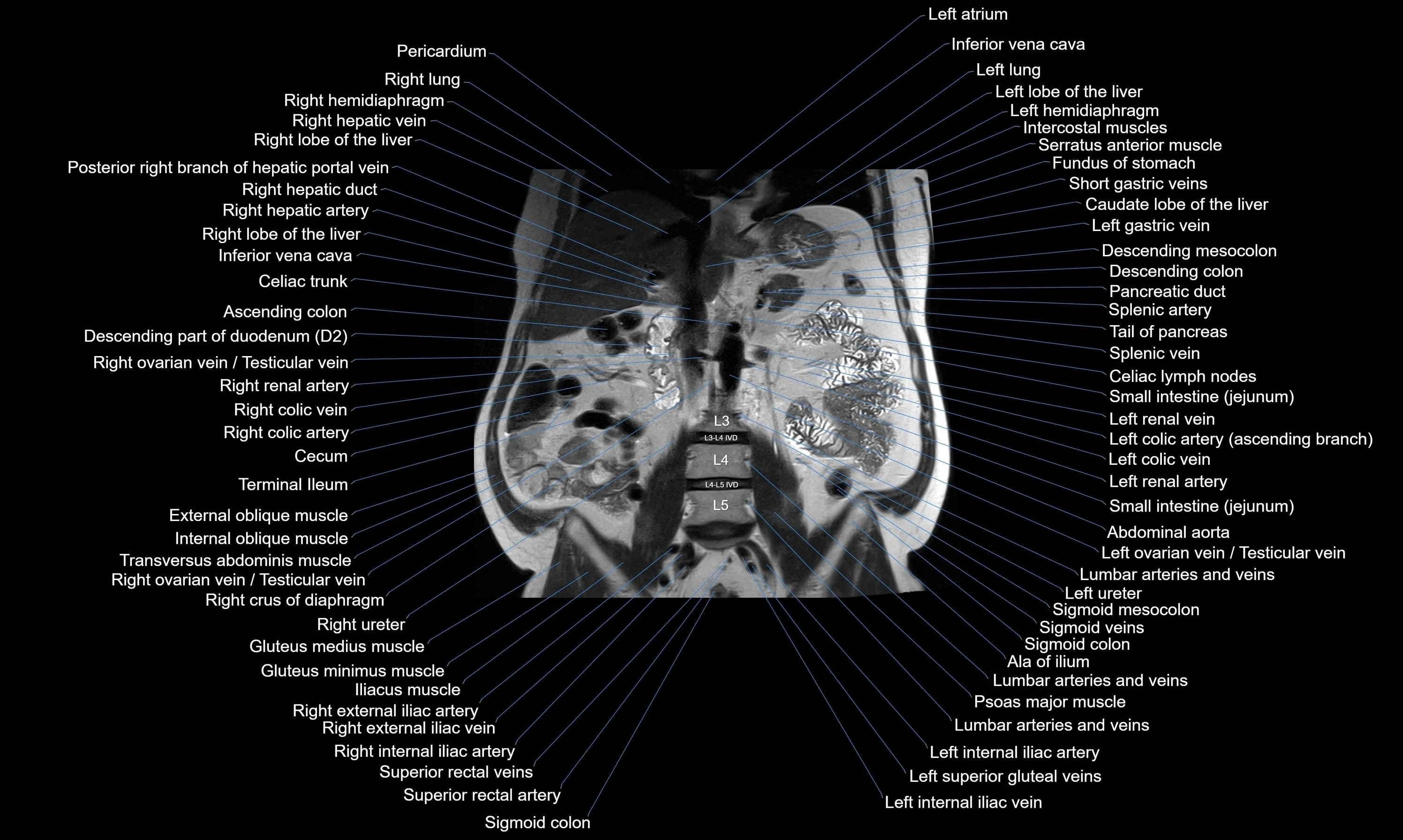 MRI Abdomen axial cross sectional anatomy radiology  image-img-00001-00032.webp